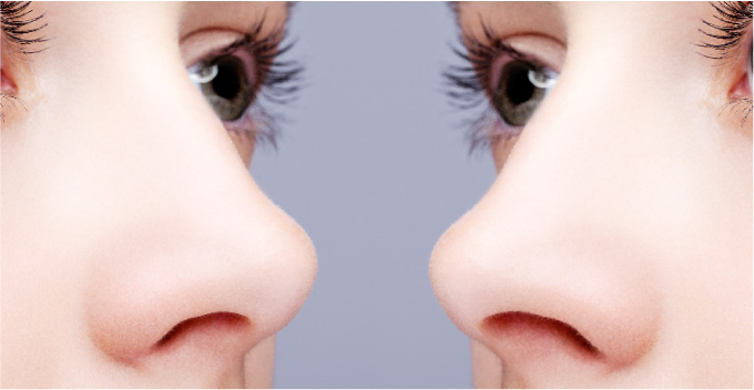 術後の左右の鼻の穴の大きさが違うことはありますか？